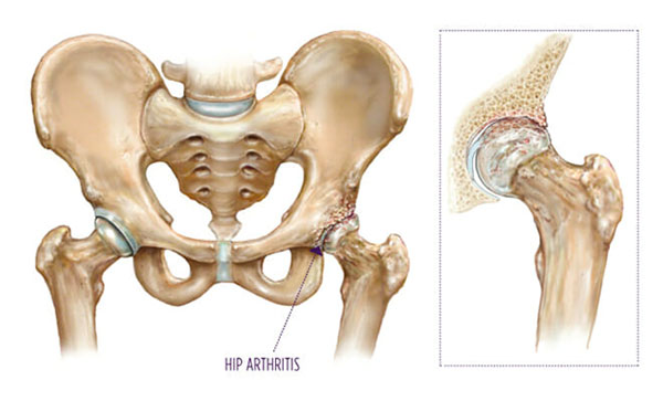 anterior-total-hip-arthroplasty
