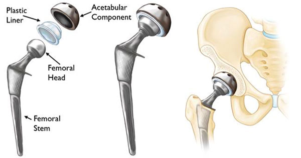 anterior-total-hip-arthroplasty