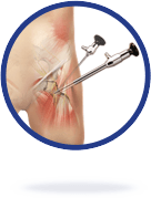 Hip Arthroscopy