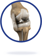 Knee Ligament Reconstruction