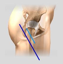 Minimally Knee Replacement