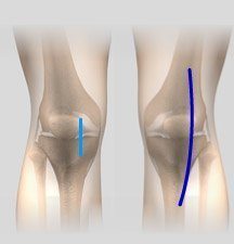 Minimally Knee Replacement
